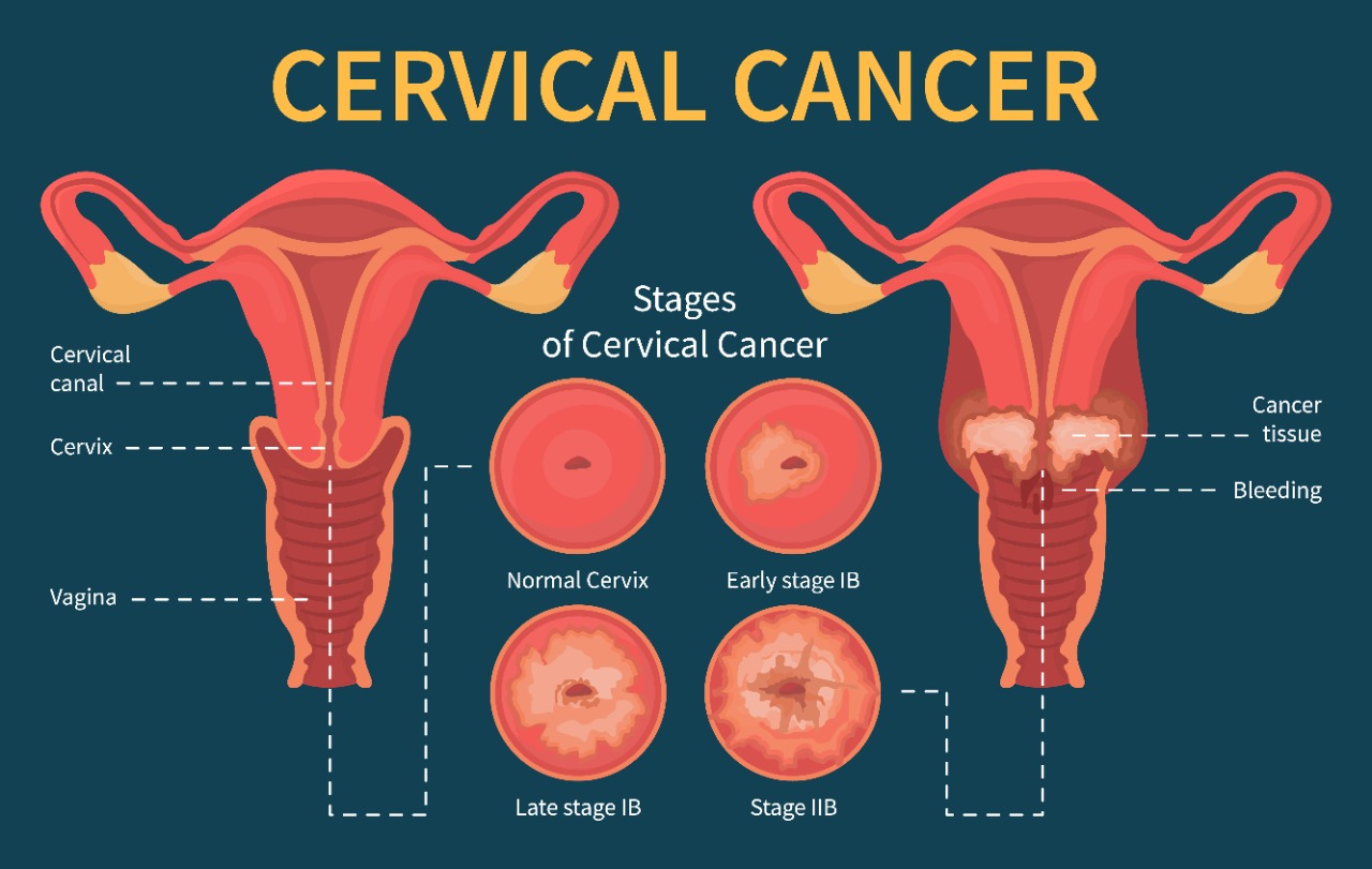 cervical cancer treatment in indore